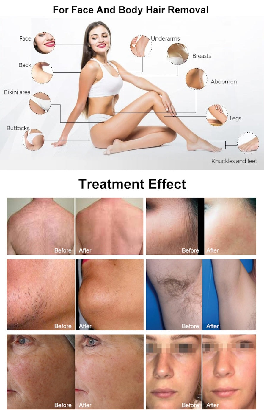 Professional Laser Hair Removal Machine 2000watt German Import Laser Bar Depilator 4 Wavelength