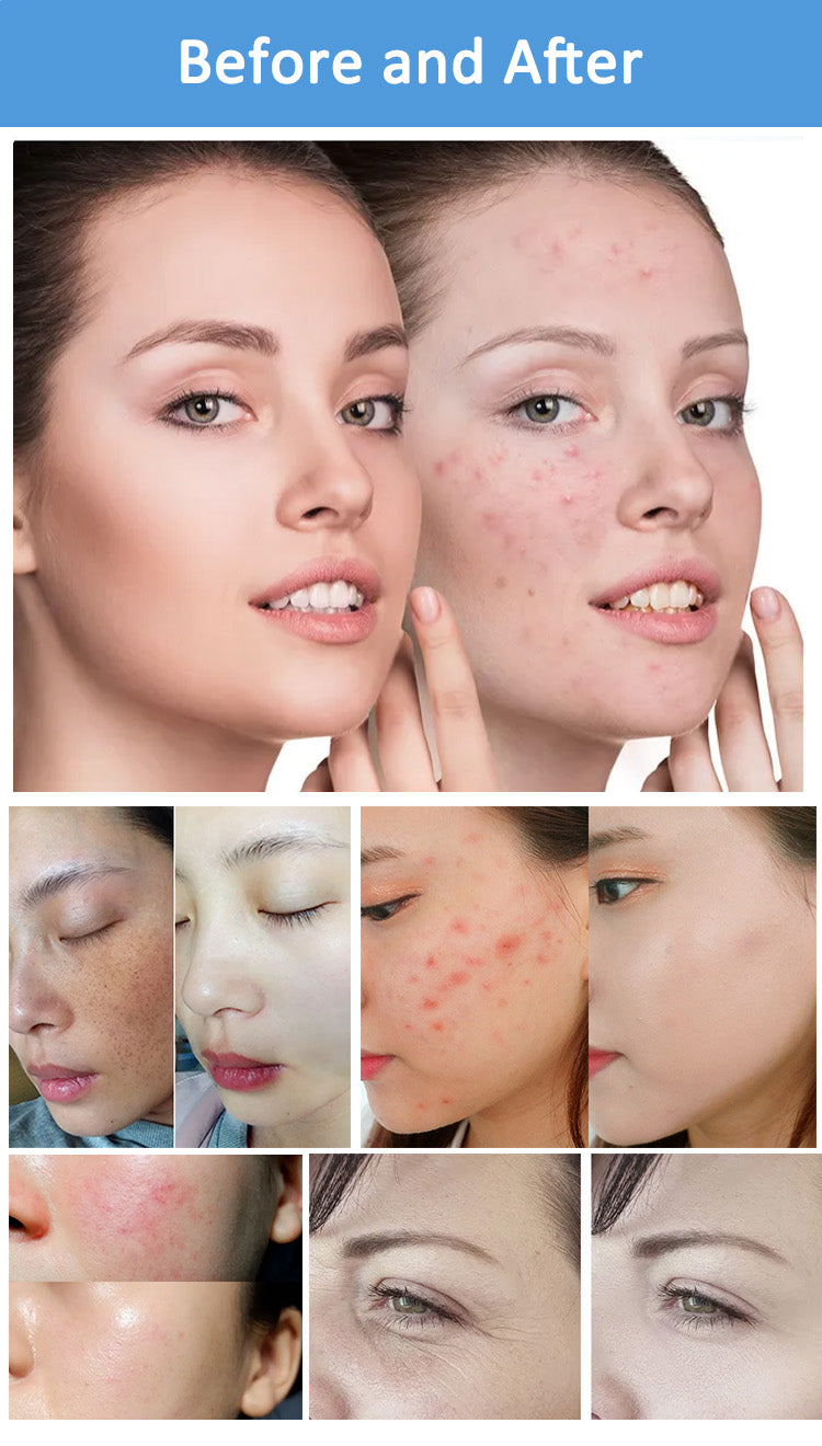 Professional RF IPL PicoLaser Tattoo Remove Machine Permanent Hair Removal E-light OPT Painless Skin Rejuvenation RF Tightening Depilator