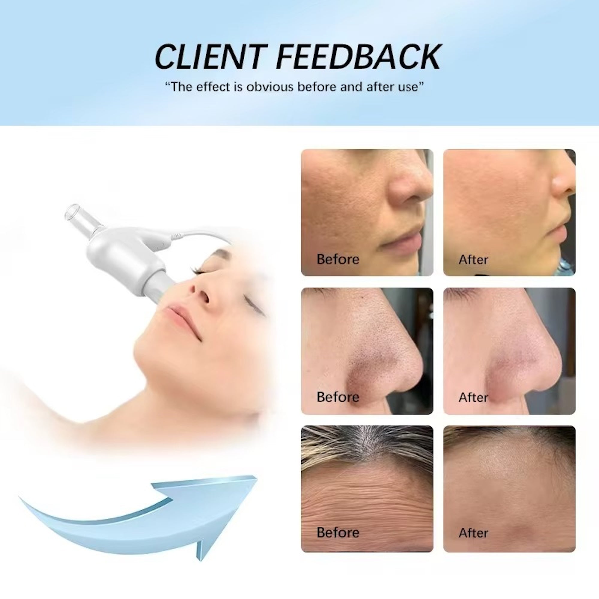 Hot Selling Home Use Effectively Introduce Skin Care EMS Product Guided Dermo Electro Proration Non-Invasive Beauty Machine