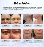 Cold Plasma Skin Care Beauty Home Use Tools Cold Plasma Instrument for Efficient Skin Rejuvenation Acne Management