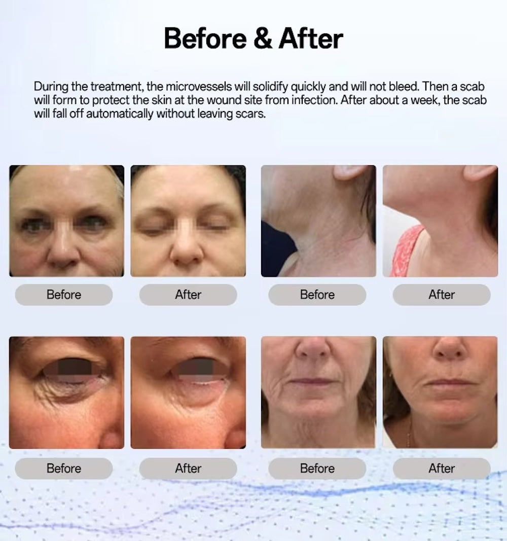 Cold Plasma Skin Care Beauty Home Use Tools Cold Plasma Instrument for Efficient Skin Rejuvenation Acne Management