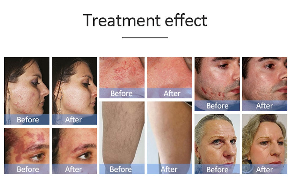 IPL OPT E-light RF 2 in 1 Permanent Hair Removal Epilator E-light Skin Rejuvenation RF Wrinkle Removal Skin Whitening