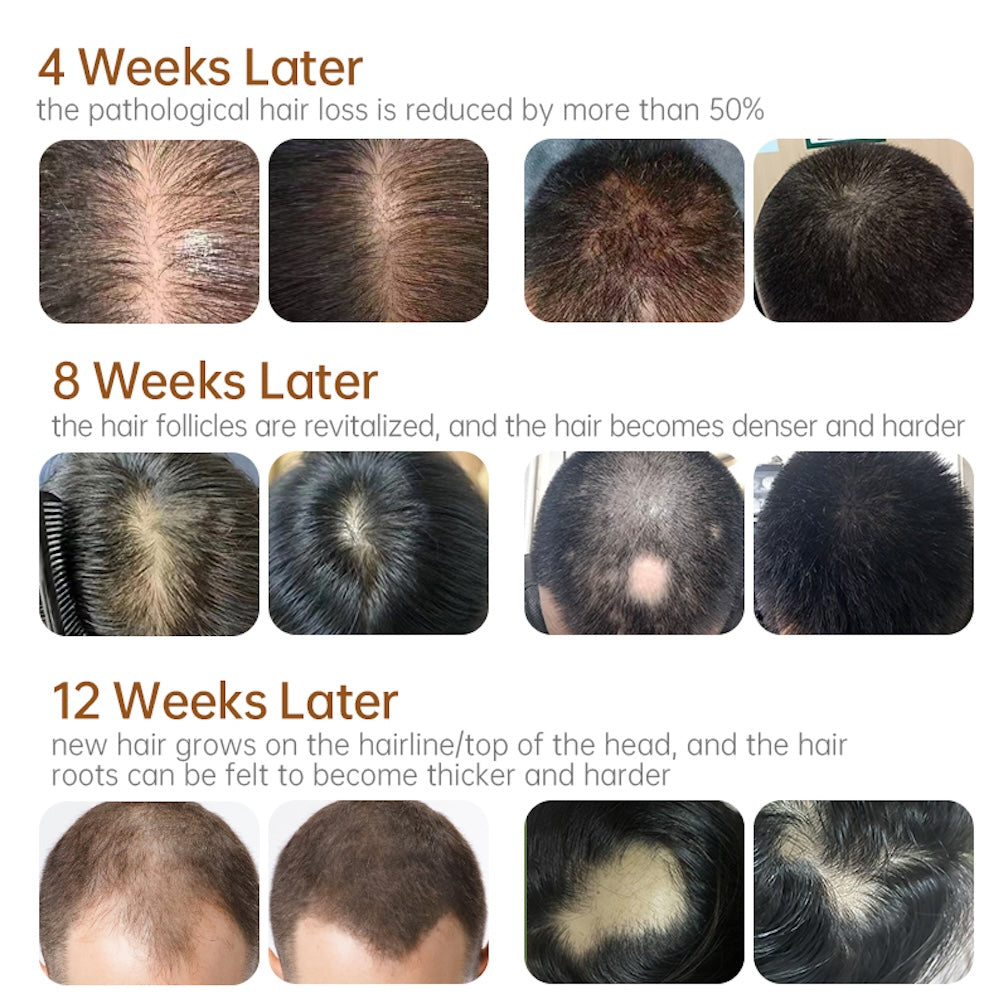 Scalp Care Serum Hair Regrowth Essence Anit-loss Hair
