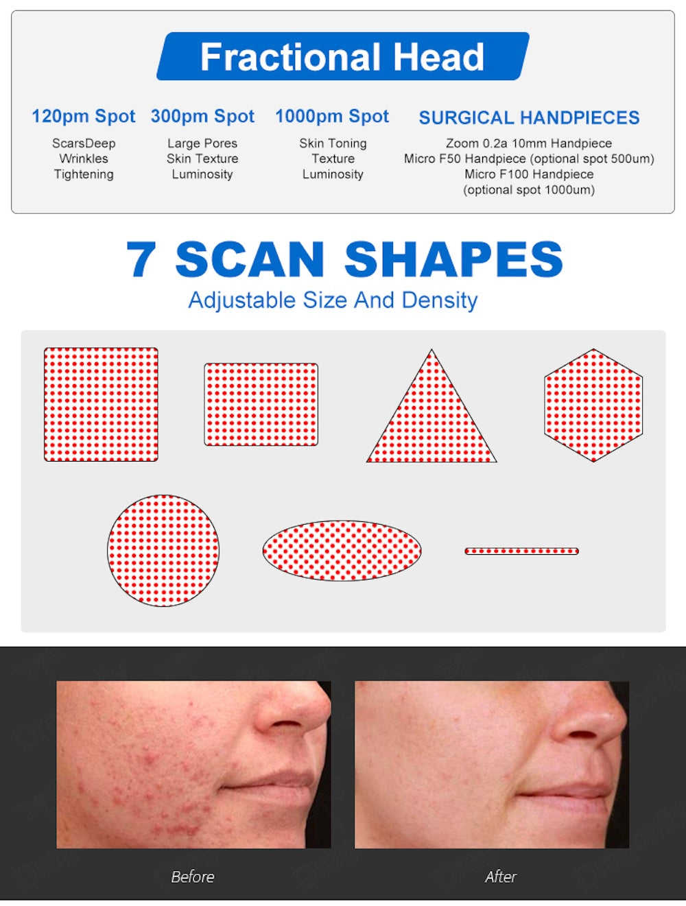 CO2 Fractional Laser Machine High Speed Stretch Mark Removal Scar Acne Treatment Vaginal Tightening