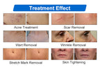 CO2 Fractional Laser Machine High Speed Stretch Mark Removal Scar Acne Treatment Vaginal Tightening