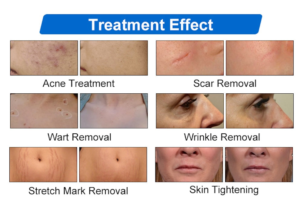CO2 Fractional Laser Machine High Speed Stretch Mark Removal Scar Acne Treatment Vaginal Tightening