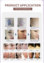 Vertical Picosecond Pico Laser Tattoo Removal Machine for Skin Resurfacing and Pigmentation Removal 755/1064/532nm