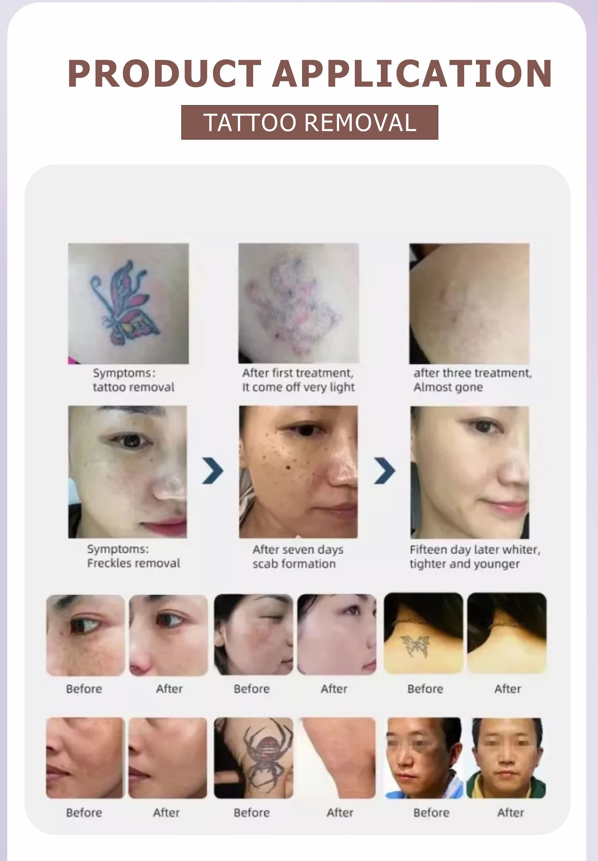 Vertical Picosecond Pico Laser Tattoo Removal Machine for Skin Resurfacing and Pigmentation Removal 755/1064/532nm